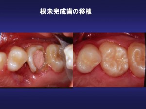 せこ歯科自家移植講義①