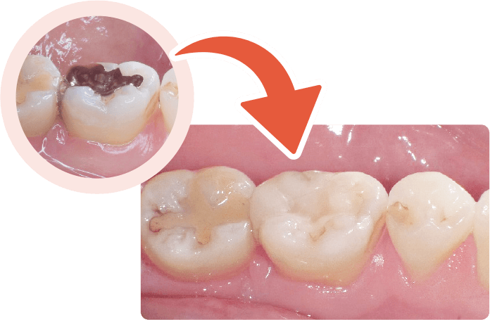 見た目が自然で美しく、銀歯よりも審美性が高い