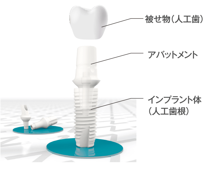 完全メタルフリーインプラント