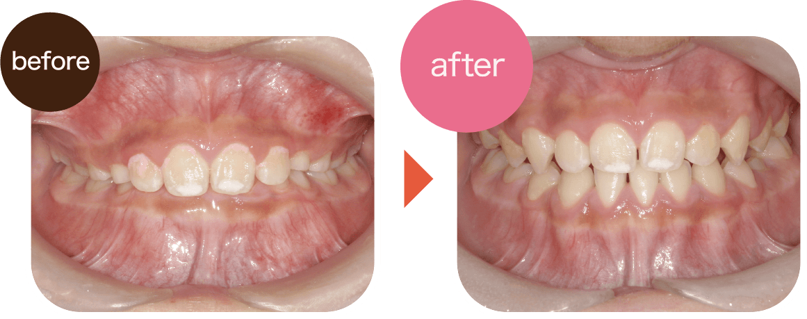 噛み合わせが深すぎるため下の歯が見えない。