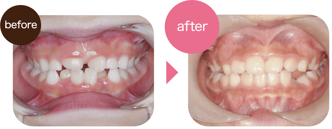 歯がガタガタになっている。