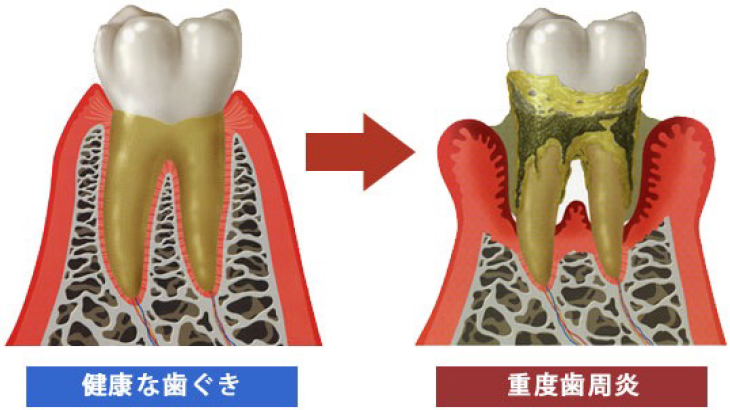 健康な歯ぐき/重度歯周炎